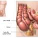 Kenali Gejala Usus Buntu